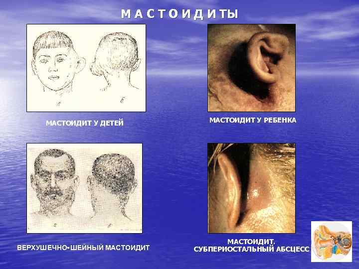 М А С Т О И Д И ТЫ МАСТОИДИТ У ДЕТЕЙ МАСТОИДИТ У