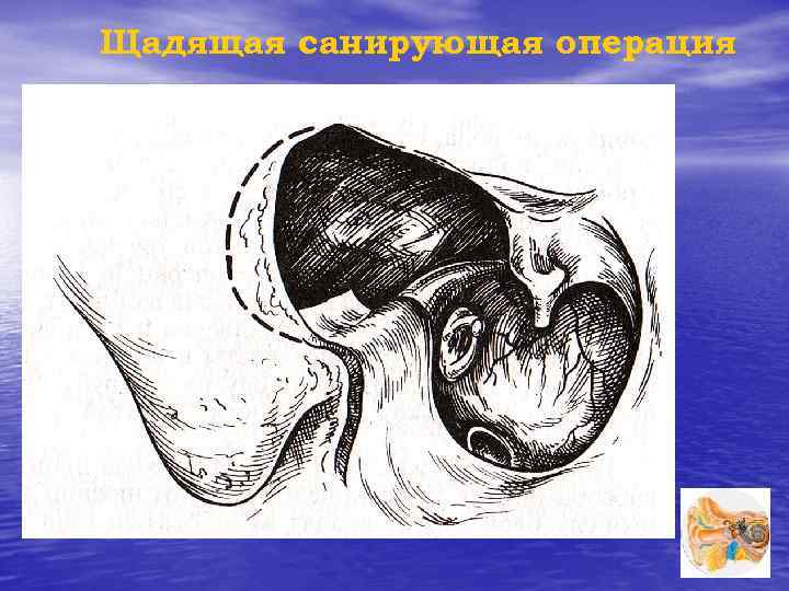 Щадящая санирующая операция 