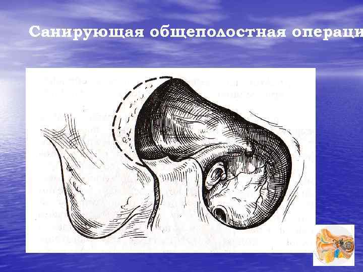 Санирующая общеполостная операци 