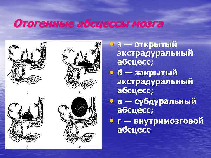 Отогенные абсцессы мозга • а — открытый • • • экстрадуральный абсцесс; б —