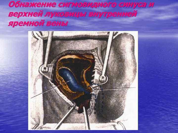 Обнажение сигмовидного синуса и верхней луковицы внутренней яремной вены 