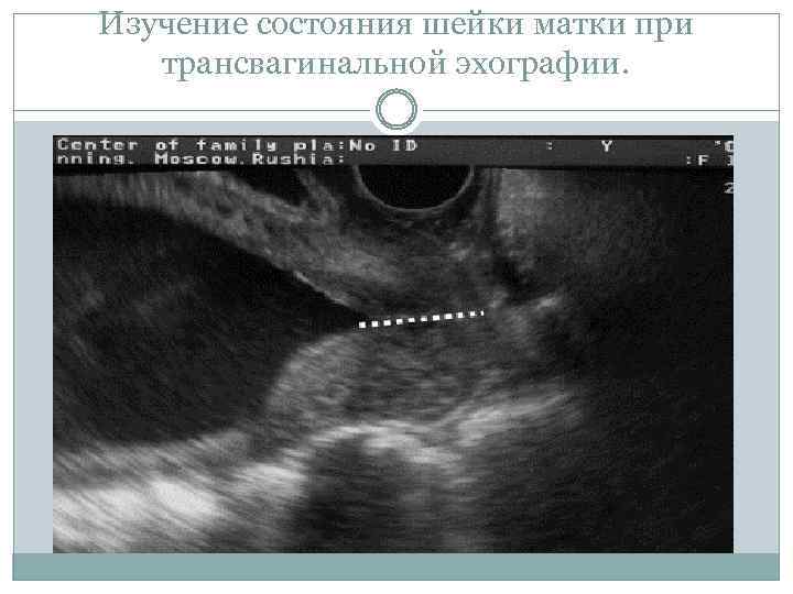 Изучение состояния шейки матки при трансвагинальной эхографии. 