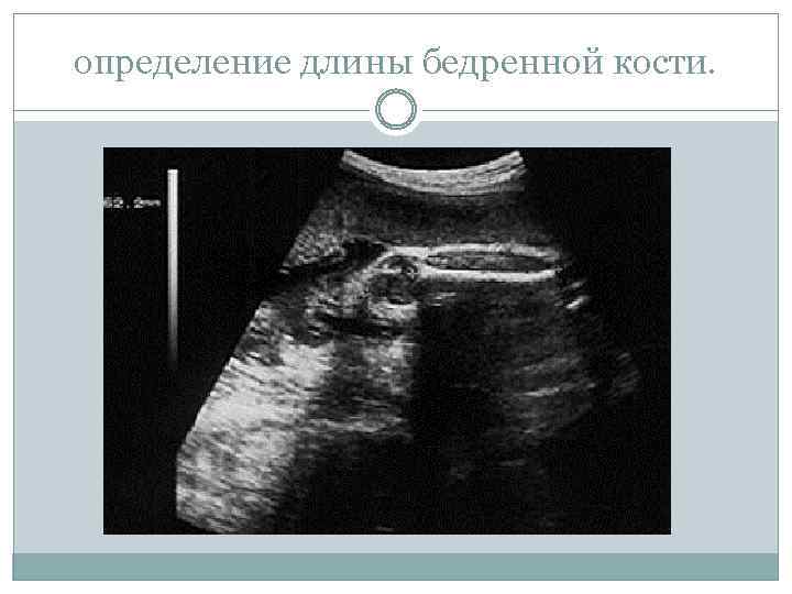 определение длины бедренной кости. 