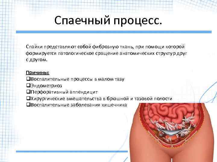 Спаечный процесс. Спайки представляют собой фиброзную ткань, при помощи которой формируется патологическое сращение анатомических