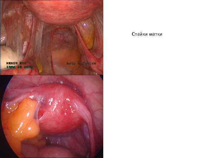 Спайки матки 