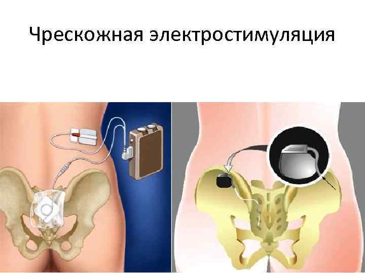 Чрескожная электростимуляция 