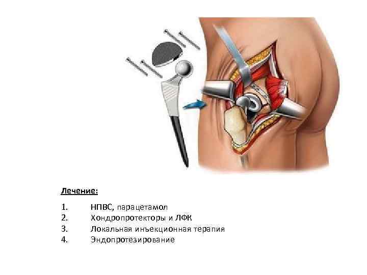 Лечение: 1. 2. 3. 4. НПВС, парацетамол Хондропротекторы и ЛФК Локальная инъекционная терапия Эндопротезирование