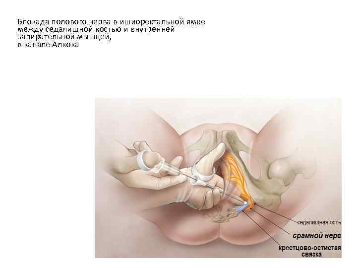 Блокада полового нерва в ишиоректальной ямке между седалищной костью и внутренней запирательной мышцей, в