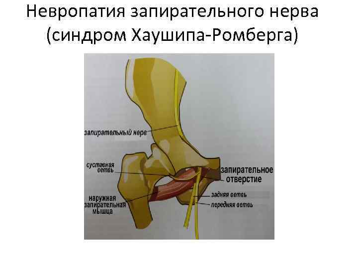 Невропатия запирательного нерва (синдром Хаушипа-Ромберга) 