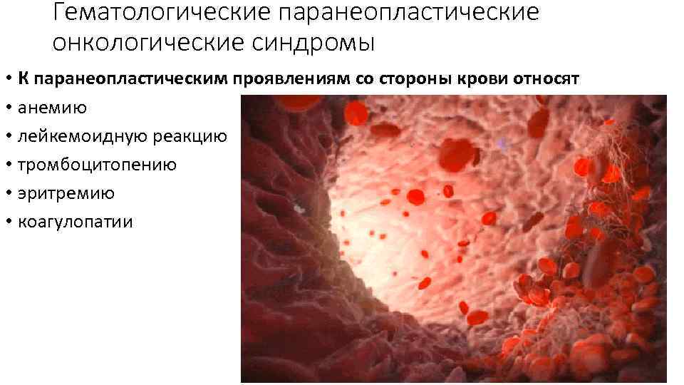 Гематологические паранеопластические онкологические синдромы • К паранеопластическим проявлениям со стороны крови относят • анемию