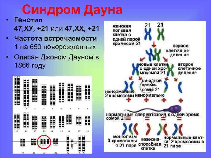 Синдром Дауна • Генотип 47, ХУ, +21 или 47, ХХ, +21 • Частота встречаемости