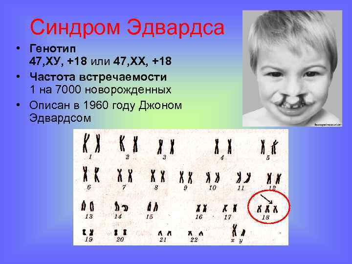 Синдром Эдвардса • Генотип 47, ХУ, +18 или 47, ХХ, +18 • Частота встречаемости