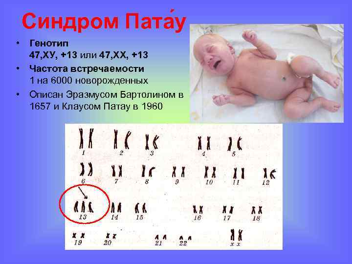 Синдром Пата у • Генотип 47, ХУ, +13 или 47, ХХ, +13 • Частота