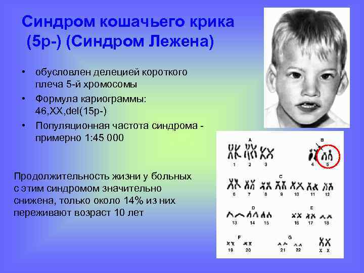 Синдром кошачьего крика (5 р-) (Синдром Лежена) • обусловлен делецией короткого плеча 5 -й