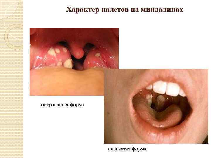  Характер налетов на миндалинах островчатая форма пленчатая форма 