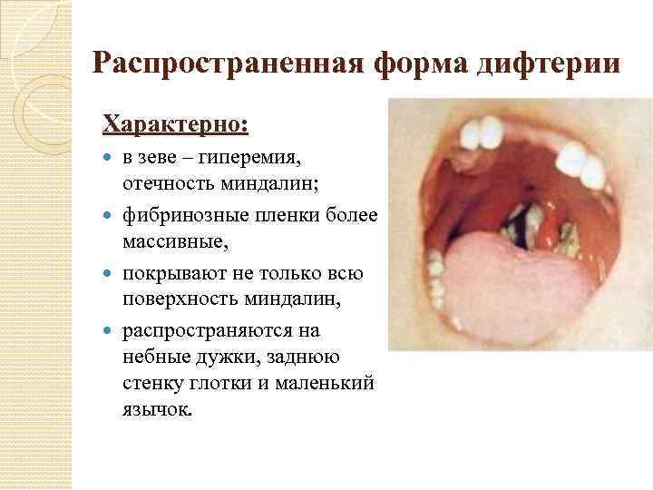 Распространенная форма дифтерии Характерно: в зеве – гиперемия, отечность миндалин; фибринозные пленки более массивные,