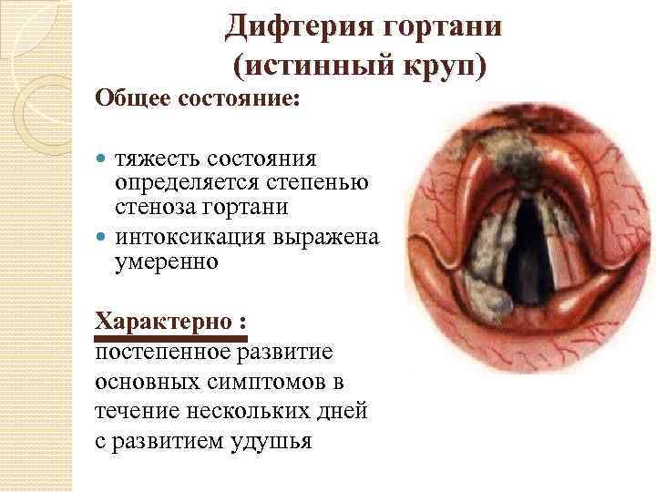 Дифтерия гортани (истинный круп) Общее состояние: тяжесть состояния определяется степенью стеноза гортани интоксикация выражена
