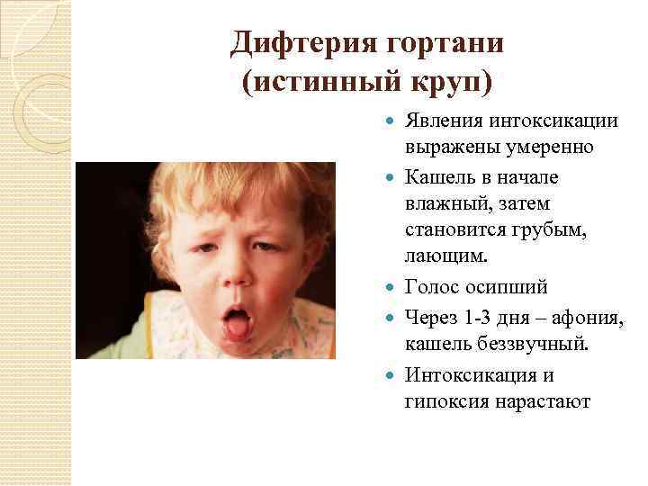 Дифтерия гортани (истинный круп) Явления интоксикации выражены умеренно Кашель в начале влажный, затем становится
