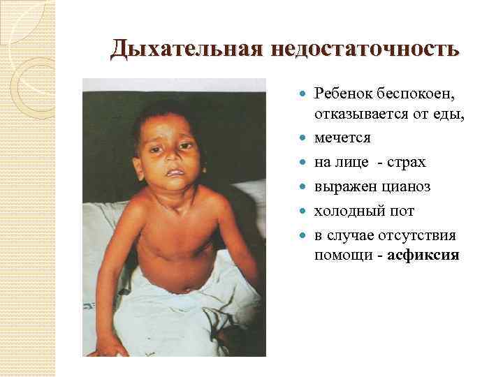 Дыхательная недостаточность Ребенок беспокоен, отказывается от еды, мечется на лице - страх выражен цианоз