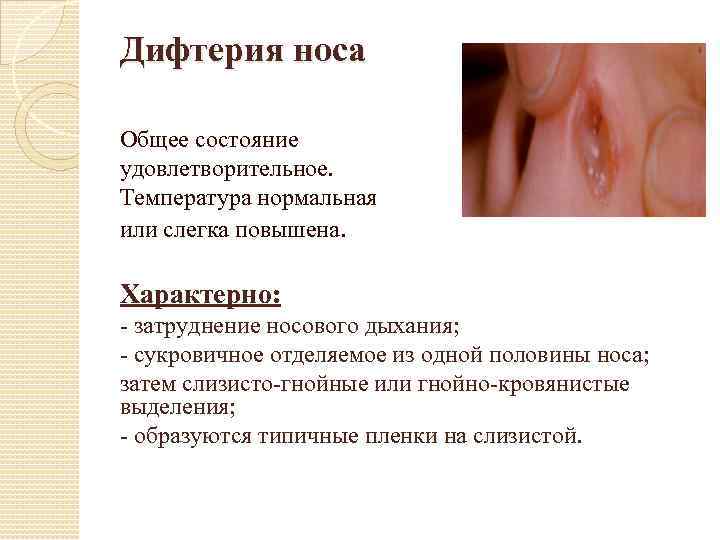 Дифтерия носа Общее состояние удовлетворительное. Температура нормальная или слегка повышена. Характерно: - затруднение носового