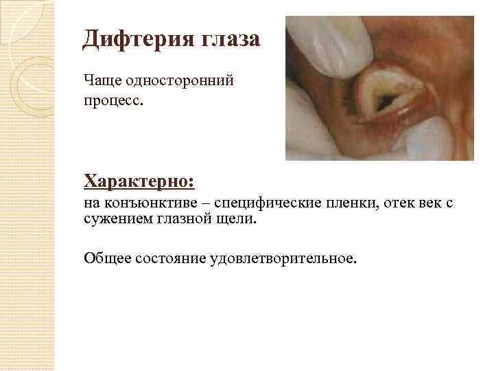 Дифтерия глаза Чаще односторонний процесс. Характерно: на конъюнктиве – специфические пленки, отек век с