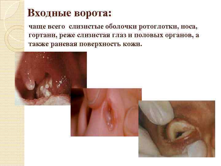 Входные ворота: чаще всего слизистые оболочки ротоглотки, носа, гортани, реже слизистая глаз и половых
