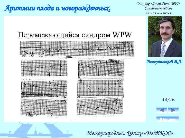 Аритмии плода и новорожденных. Болсуновский В. А. 14/26 Лекции 