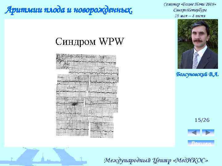 Аритмии плода и новорожденных. Болсуновский В. А. 15/26 Лекции 