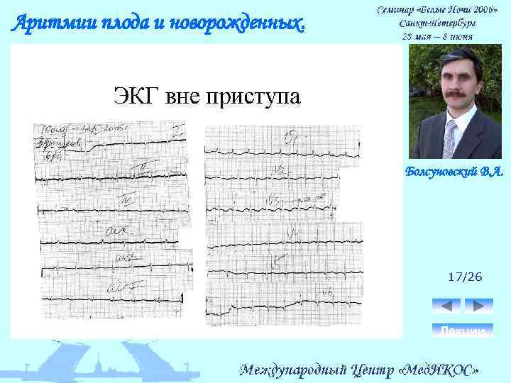 Аритмии плода и новорожденных. Болсуновский В. А. 17/26 Лекции 