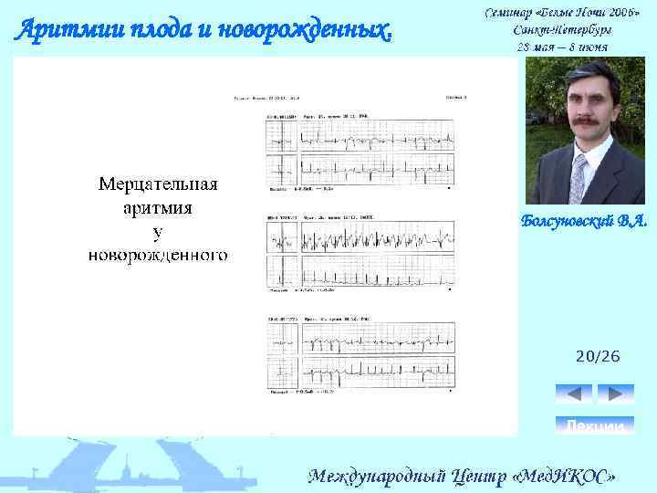 Аритмии плода и новорожденных. Болсуновский В. А. 20/26 Лекции 