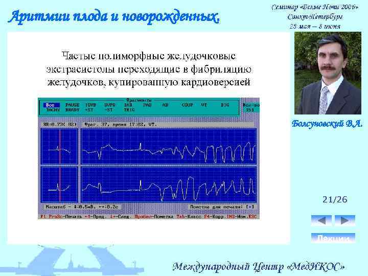 Аритмии плода и новорожденных. Болсуновский В. А. 21/26 Лекции 