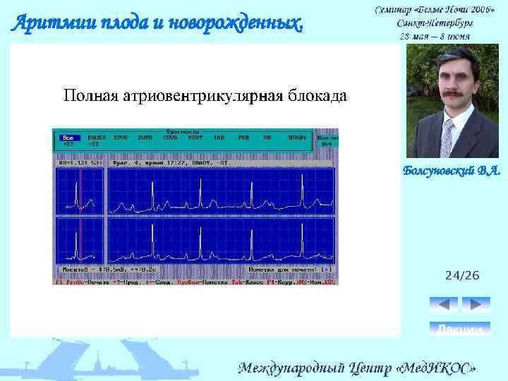 Аритмии плода и новорожденных. Болсуновский В. А. 24/26 Лекции 