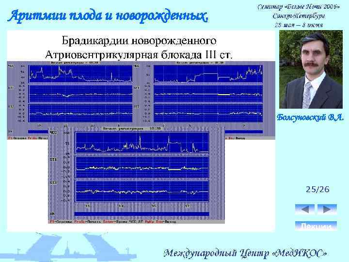 Аритмии плода и новорожденных. Болсуновский В. А. 25/26 Лекции 