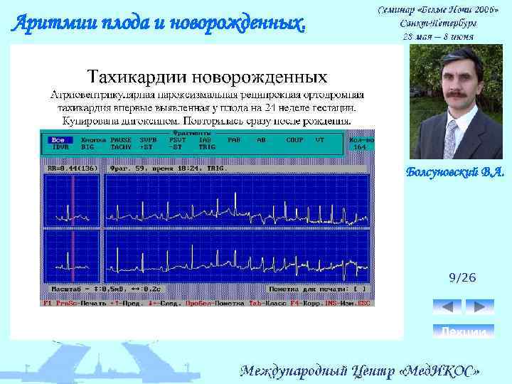 Аритмии плода и новорожденных. Болсуновский В. А. 9/26 Лекции 