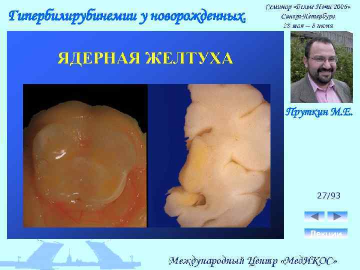 Гипербилирубинемии у новорожденных. Пруткин М. Е. 27/93 Лекции 