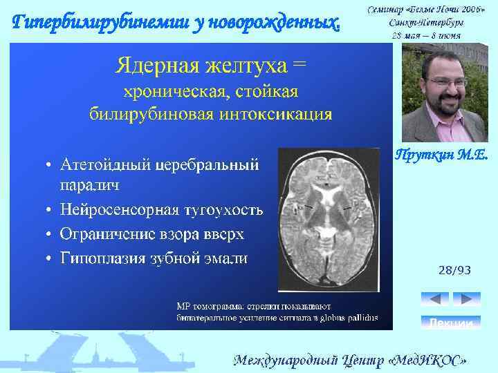 Гипербилирубинемии у новорожденных. Пруткин М. Е. 28/93 Лекции 