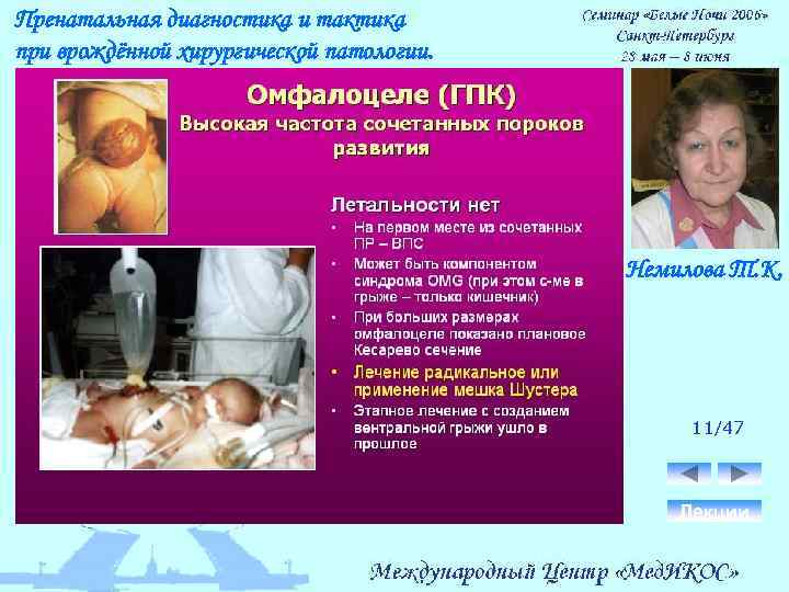 Пренатальная диагностика и тактика при врождённой хирургической патологии. Немилова Т. К. 11/47 Лекции 