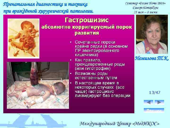 Пренатальная диагностика и тактика при врождённой хирургической патологии. Немилова Т. К. 13/47 Лекции 
