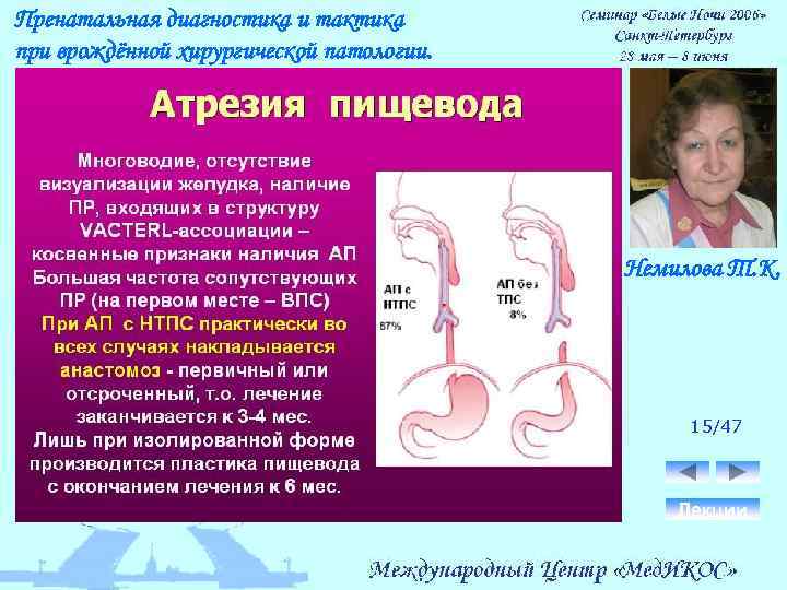 Пренатальная диагностика и тактика при врождённой хирургической патологии. Немилова Т. К. 15/47 Лекции 