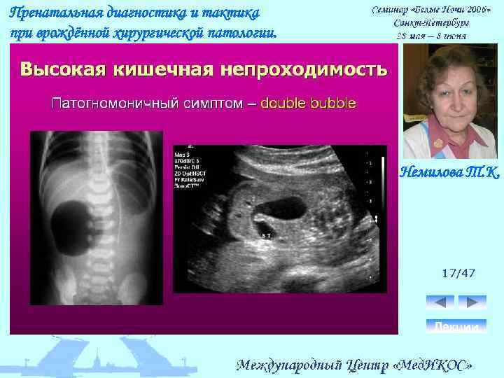 Пренатальная диагностика и тактика при врождённой хирургической патологии. Немилова Т. К. 17/47 Лекции 