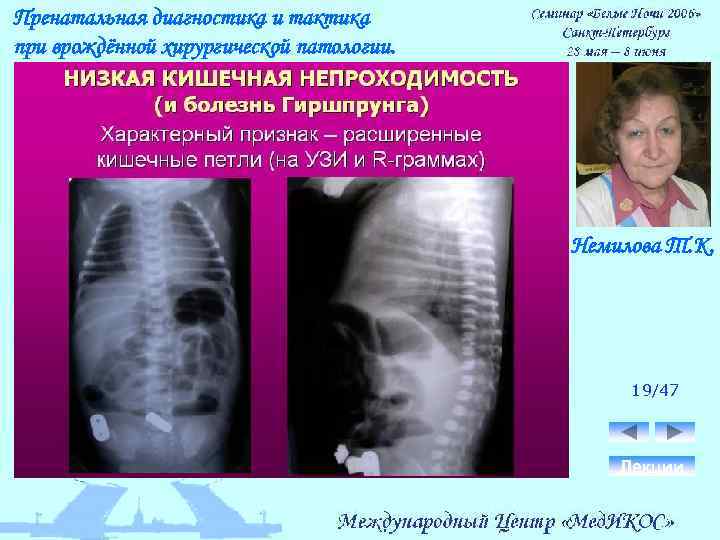 Пренатальная диагностика и тактика при врождённой хирургической патологии. Немилова Т. К. 19/47 Лекции 