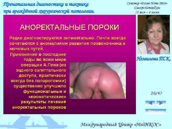 Пренатальная диагностика и тактика при врождённой хирургической патологии. Немилова Т. К. 26/47 Лекции 