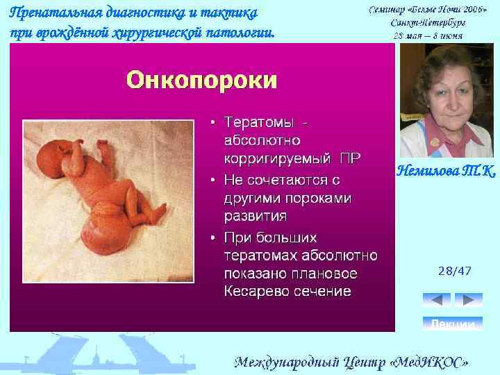 Пренатальная диагностика и тактика при врождённой хирургической патологии. Немилова Т. К. 28/47 Лекции 