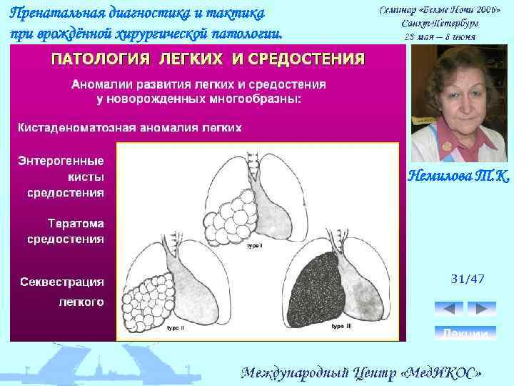 Пренатальная диагностика и тактика при врождённой хирургической патологии. Немилова Т. К. 31/47 Лекции 