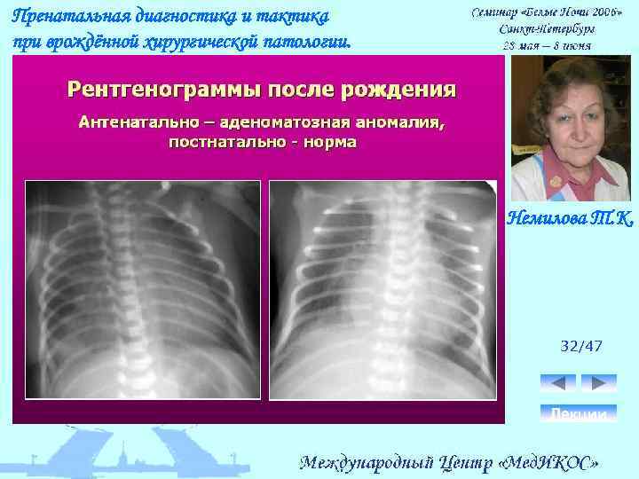Пренатальная диагностика и тактика при врождённой хирургической патологии. Немилова Т. К. 32/47 Лекции 