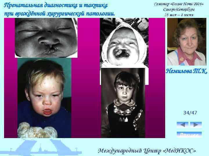 Пренатальная диагностика и тактика при врождённой хирургической патологии. Немилова Т. К. 34/47 Лекции 
