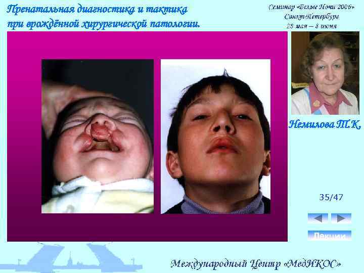 Пренатальная диагностика и тактика при врождённой хирургической патологии. Немилова Т. К. 35/47 Лекции 