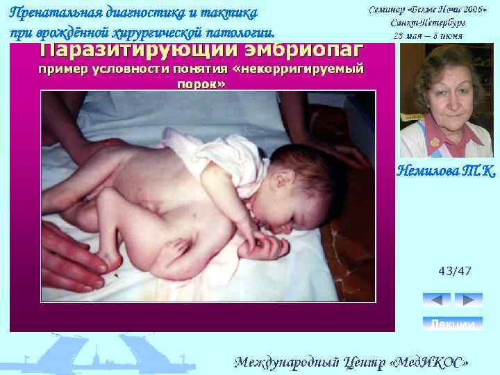 Пренатальная диагностика и тактика при врождённой хирургической патологии. Немилова Т. К. 43/47 Лекции 