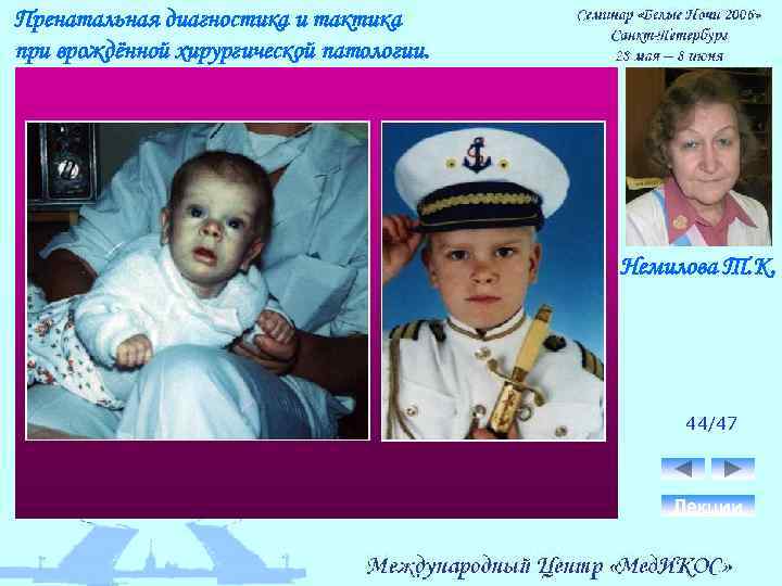 Пренатальная диагностика и тактика при врождённой хирургической патологии. Немилова Т. К. 44/47 Лекции 