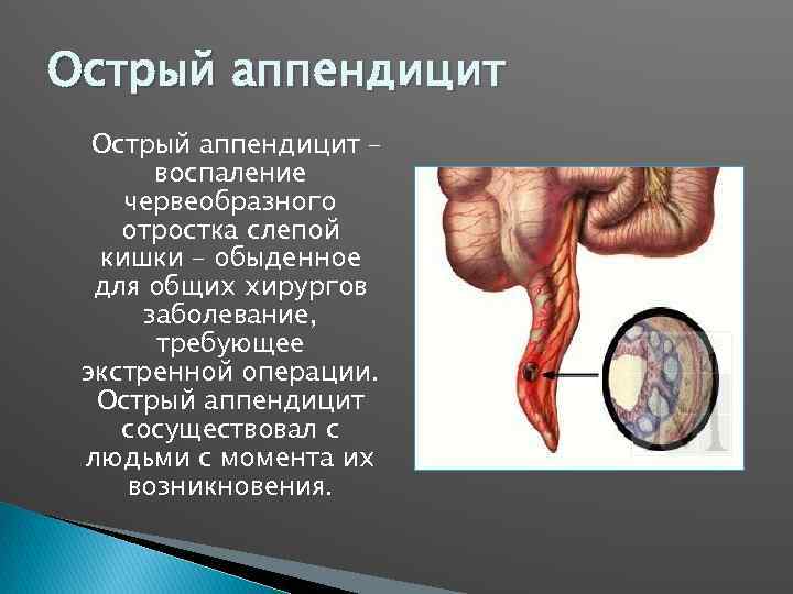 Острый аппендицит – воспаление червеобразного отростка слепой кишки – обыденное для общих хирургов заболевание,